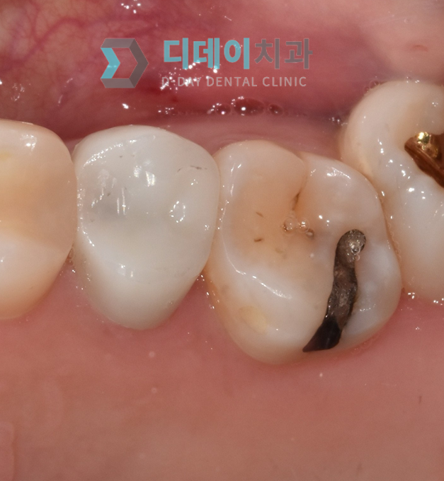 아말감 교체 (레진 치료) 치료 전