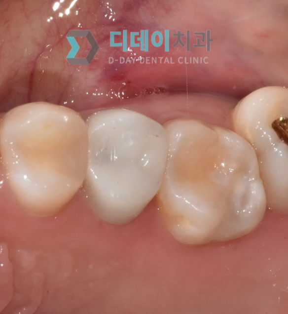 아말감 교체 (레진 치료) 치료 후