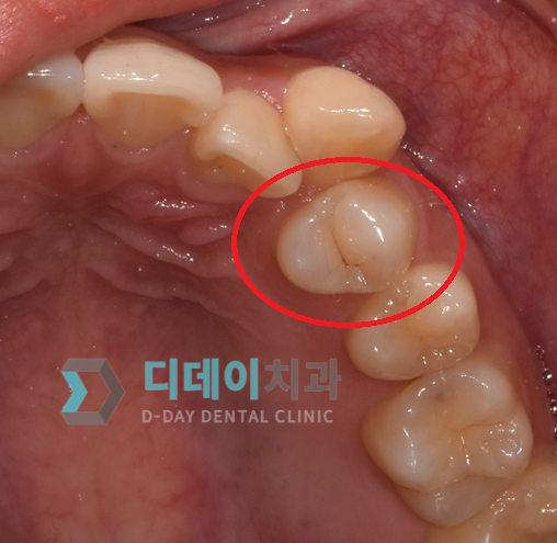 어금니 충치 치료 (레진 치료) 치료 전