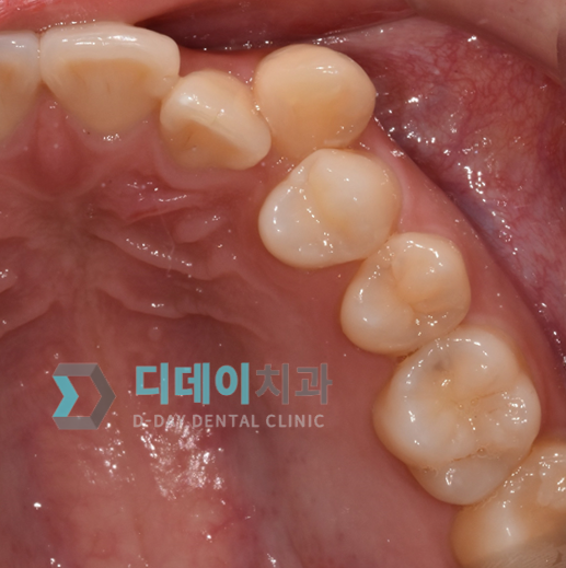 어금니 충치 치료 (레진 치료) 치료 후