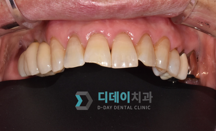치아성형 (심미 레진 치료) 치료 전