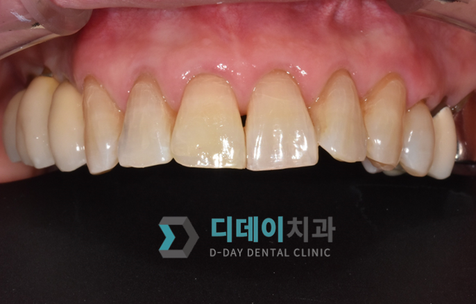 치아성형 (심미 레진 치료) 치료 후