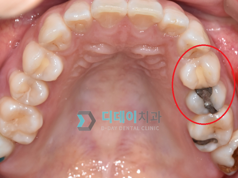 치료 전 사진입니다.