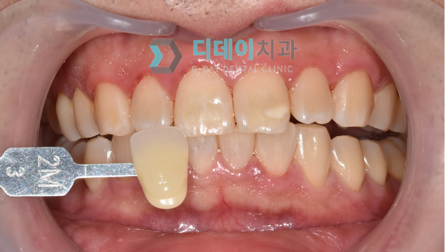 치료 전 사진입니다.
