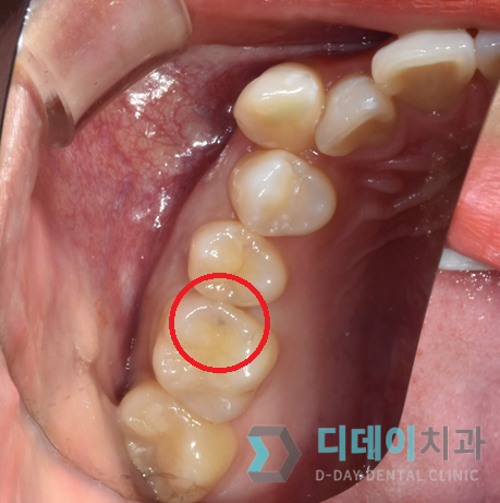 치료 전 사진입니다.