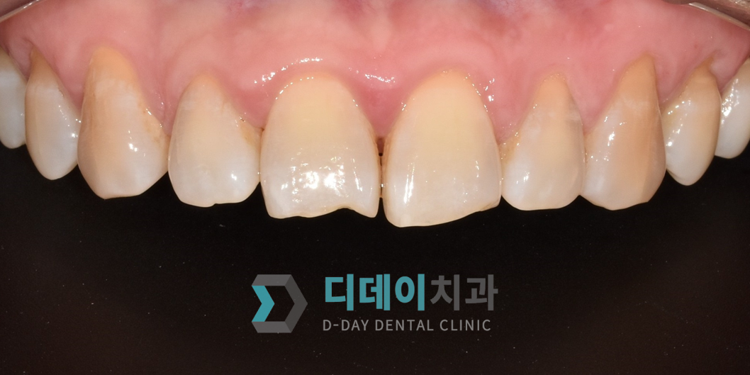 치료 전 사진입니다.