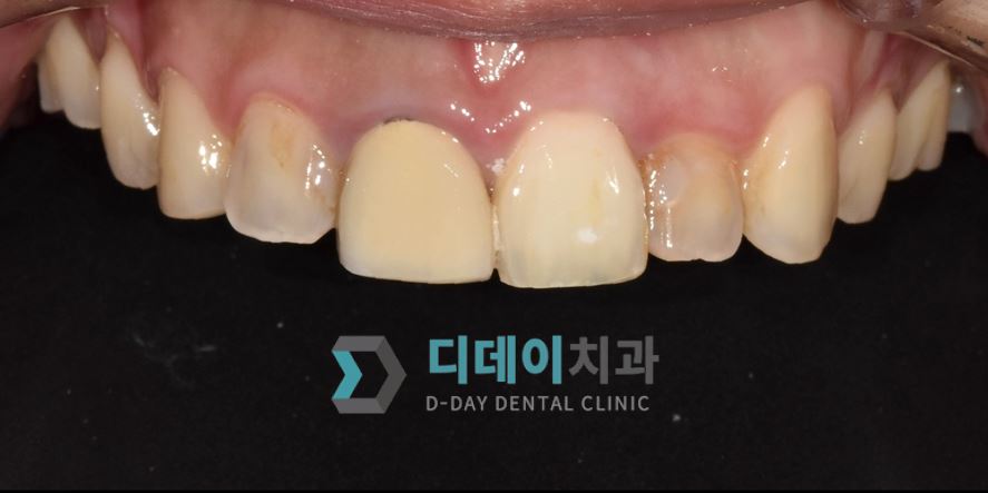치료 전 사진입니다.