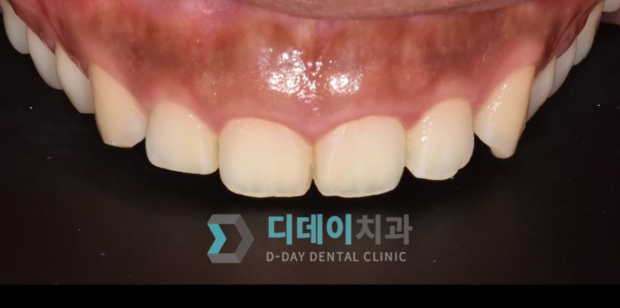 치료 전 사진입니다.