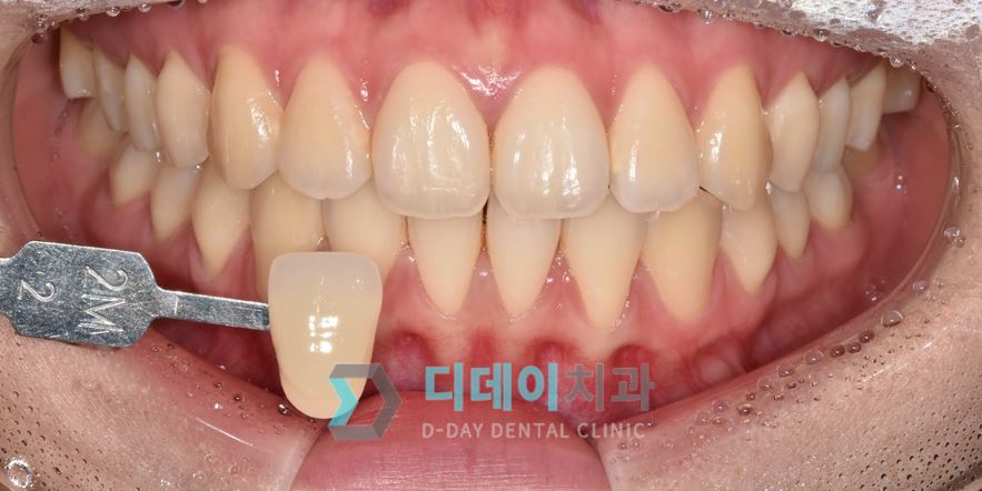 치료 전 사진입니다.