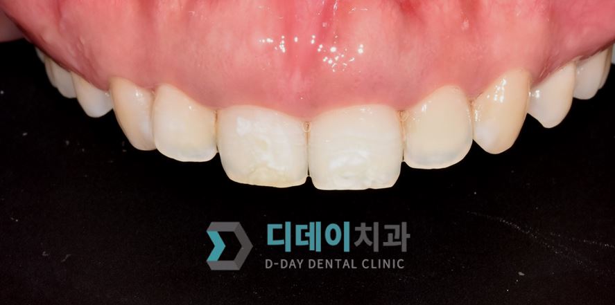 치료 전 사진입니다.
