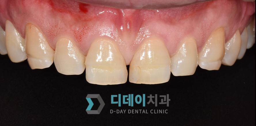 치료 전 사진입니다.