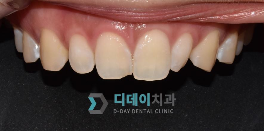 치료 전 사진입니다.