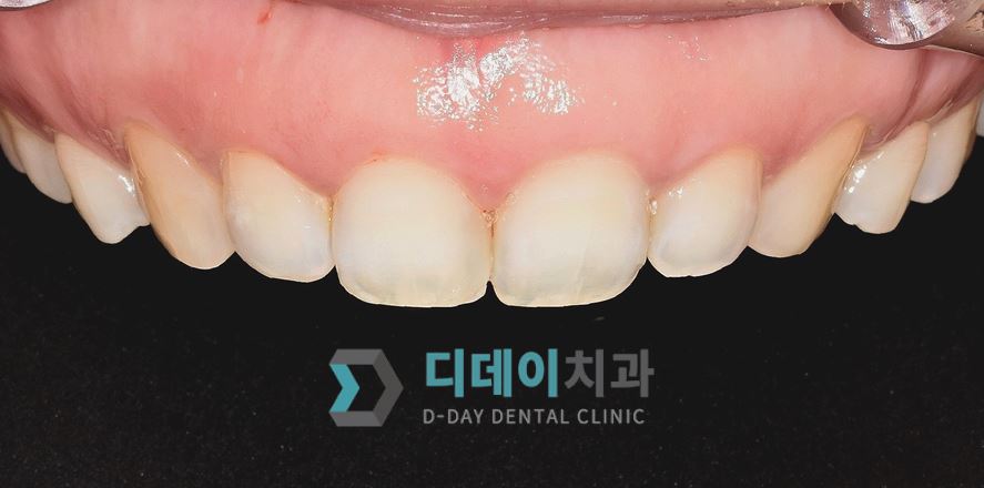 치료 전 사진입니다.