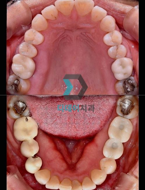 치료 전 사진입니다.