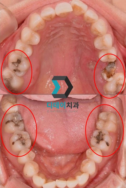 치료 전 사진입니다.