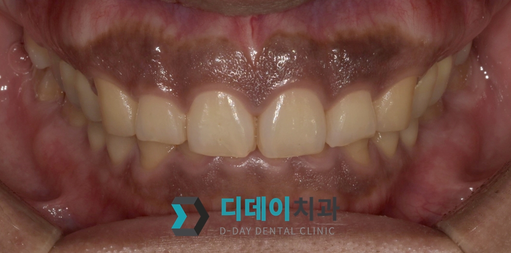 잇몸 미백 치료 전