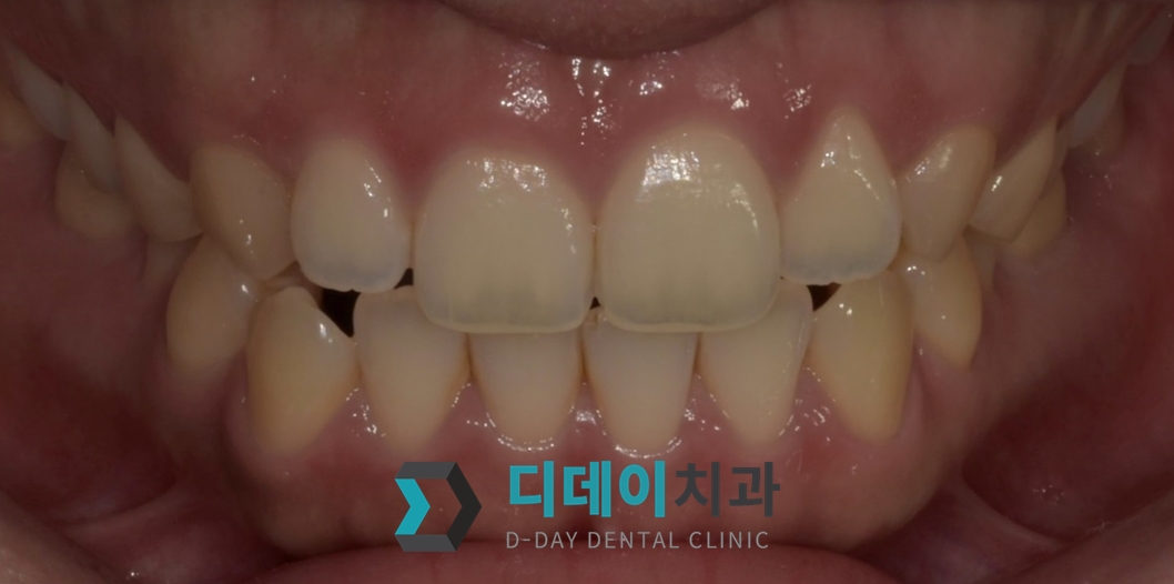잇몸 성형 치료 전