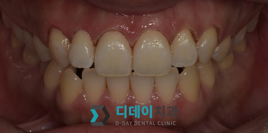 잇몸 성형 치료 후