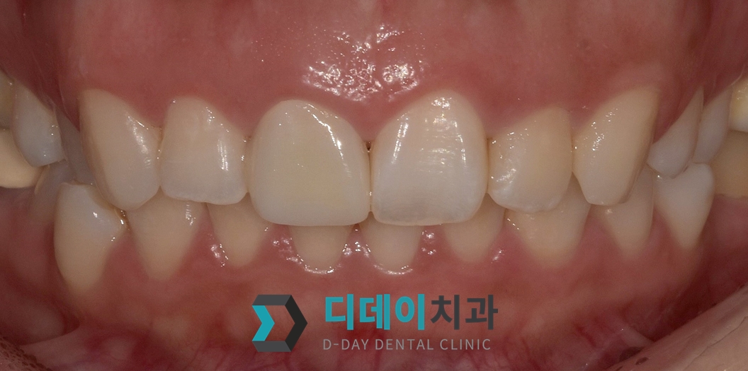 지르코니아 크라운 치료 후