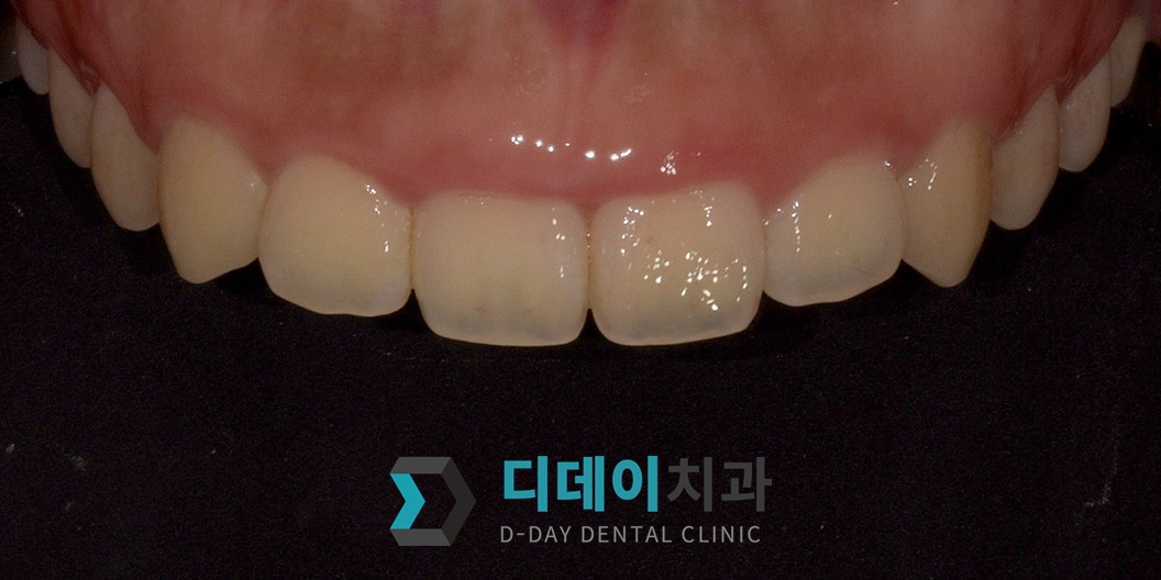잇몸 성형 치료 전