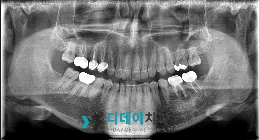 임플란트 (발치후 즉시식립) 치료 전