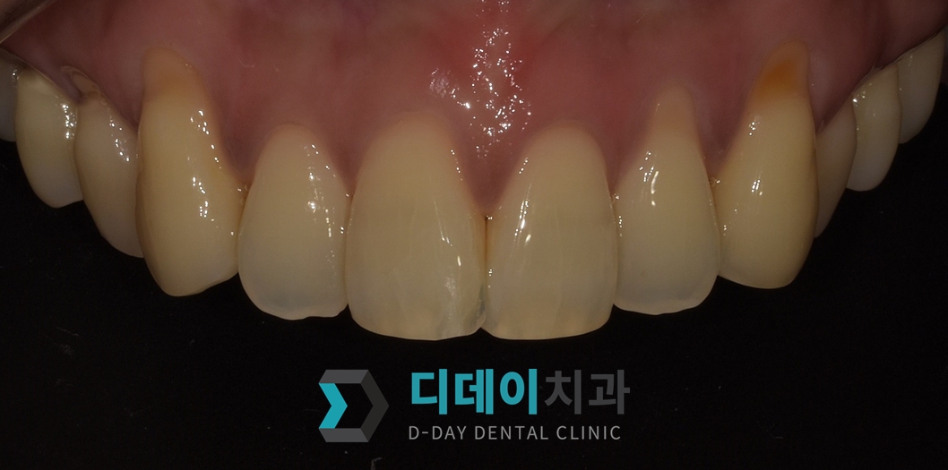 치아 성형 (법랑질 성형) 치료 후