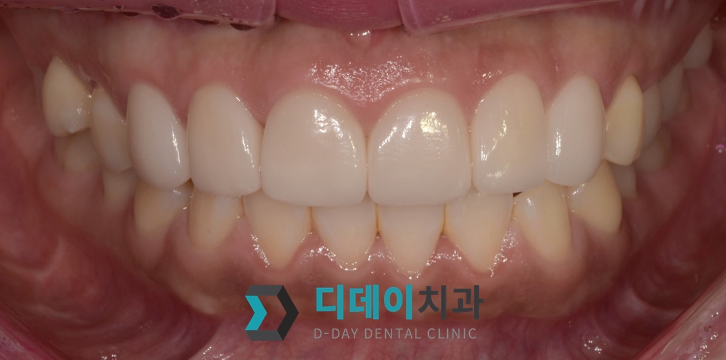 라미네이트 치료 후