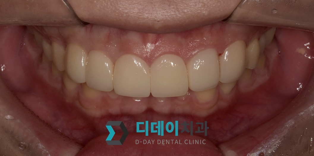 라미네이트 치료 후
