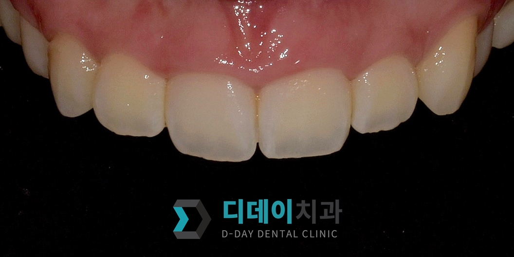 잇몸 성형 치료 전