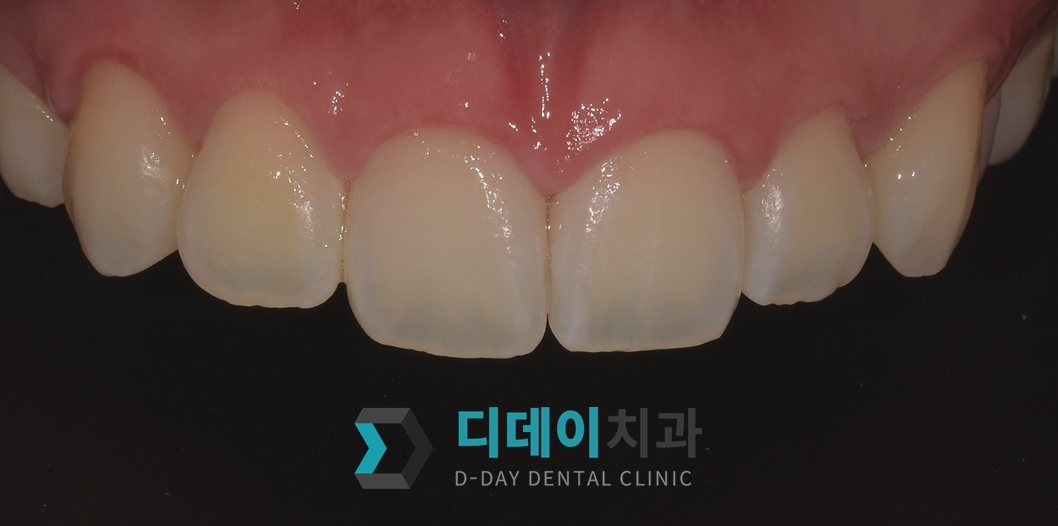 잇몸 성형 치료 후