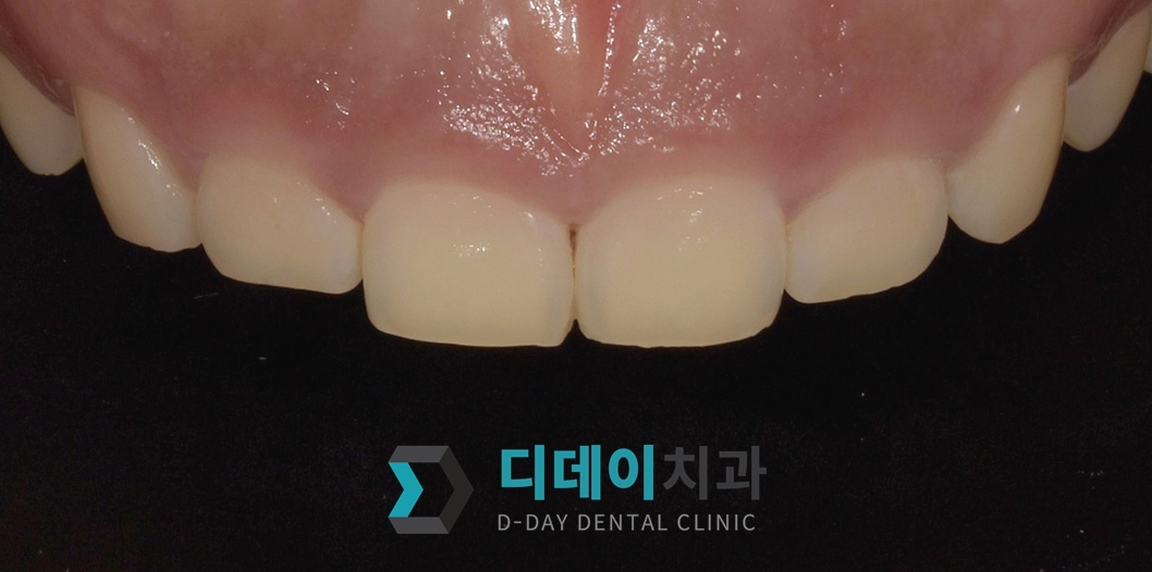 잇몸 성형 치료 전
