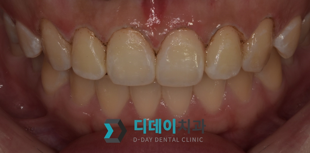 잇몸 성형 치료 후