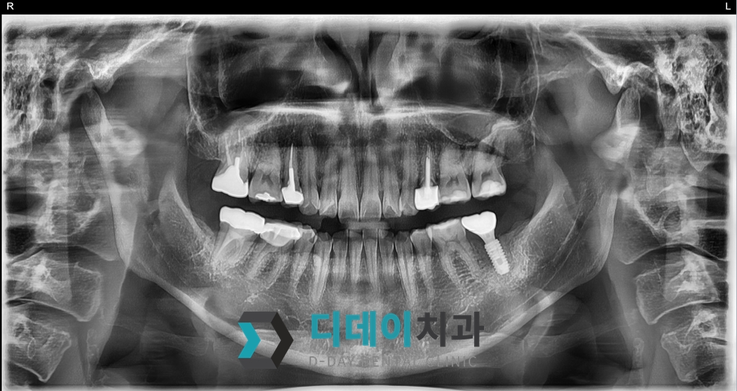 임플란트 (발치후 지연식립) 치료 후