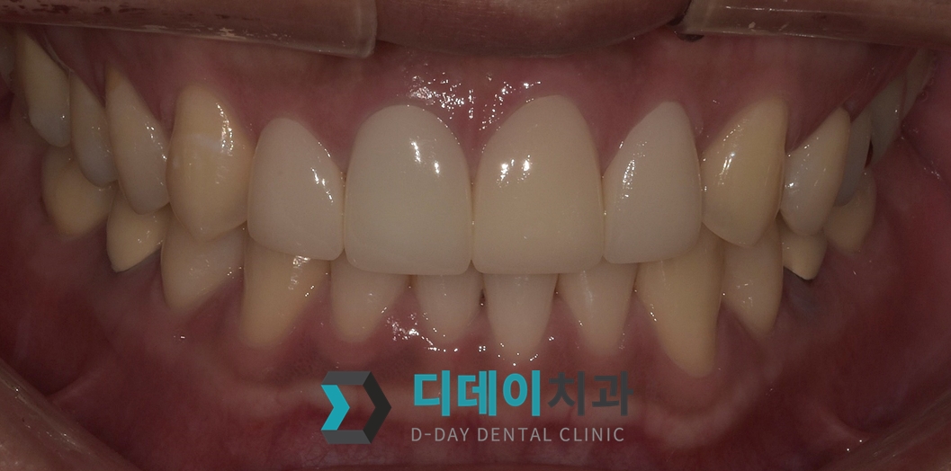 라미네이트 치료 후