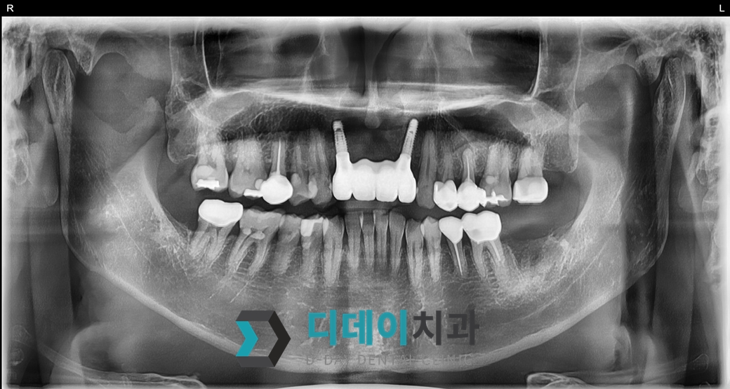 임플란트 (발치후 즉시식립) 치료 후