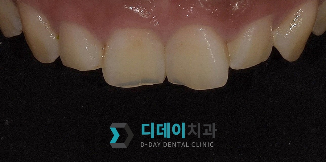 치아 성형 (법랑질 성형) 치료 전