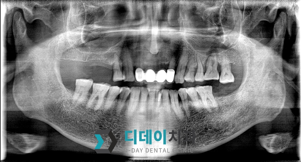 임플란트 치료 전