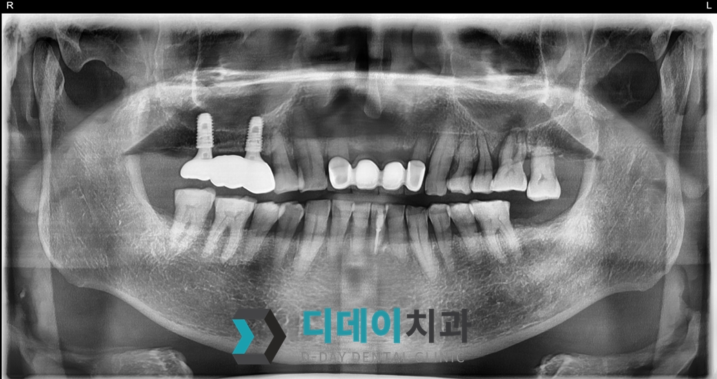 임플란트 치료 후