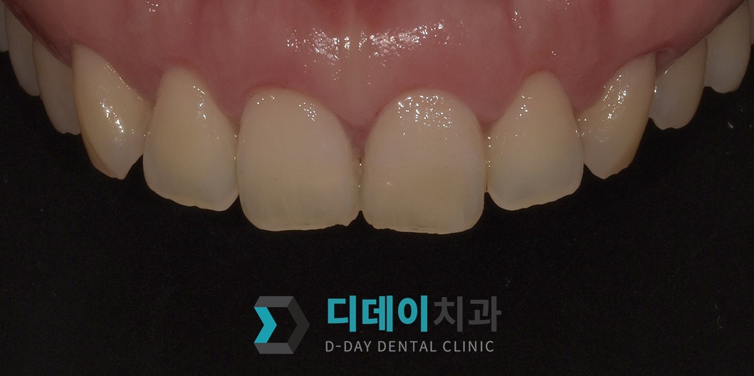 잇몸성형 치료 후