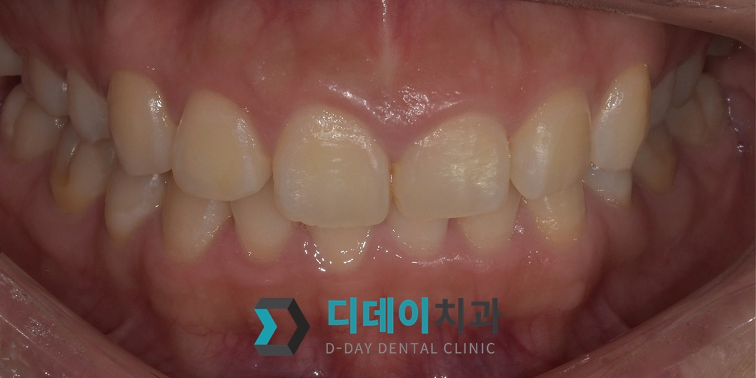 잇몸 성형 치료 전