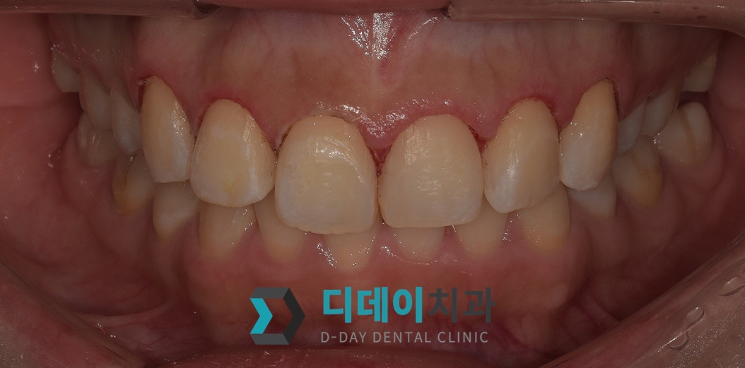 잇몸 성형 치료 후