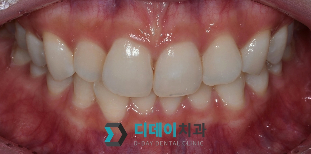 라미네이트 치료 전