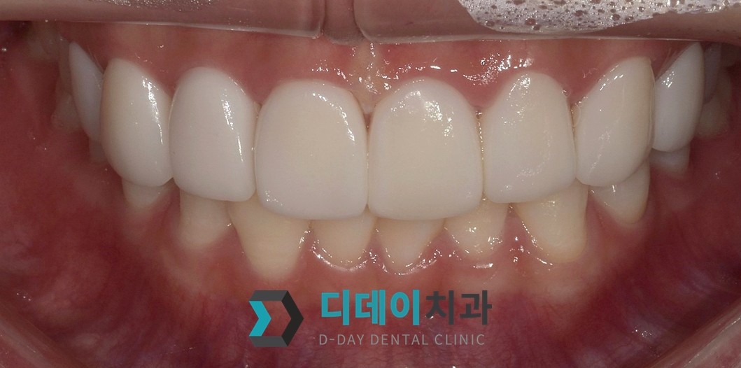 라미네이트 치료 후