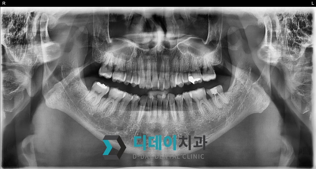 임플란트 (발치후 즉시식립) 치료 전