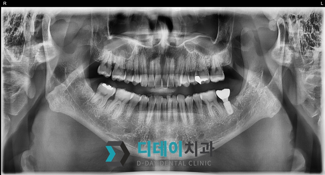 임플란트 (발치후 즉시식립) 치료 후