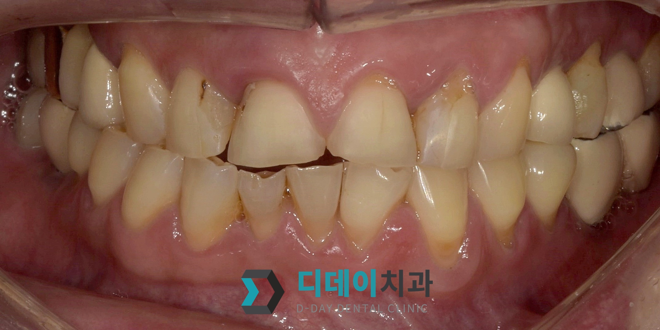 지르코니아 크라운 치료 전