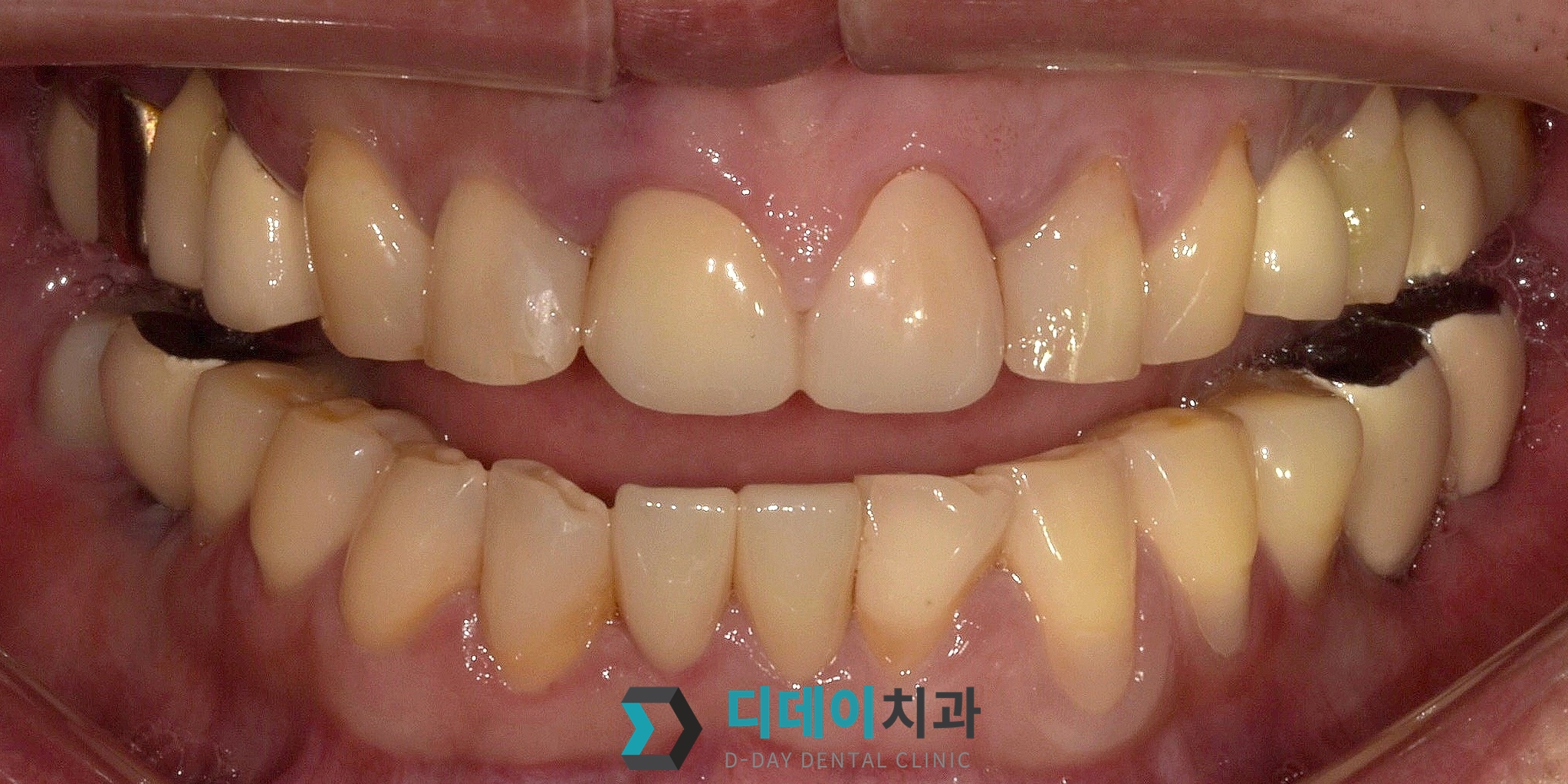 지르코니아 크라운 치료 후