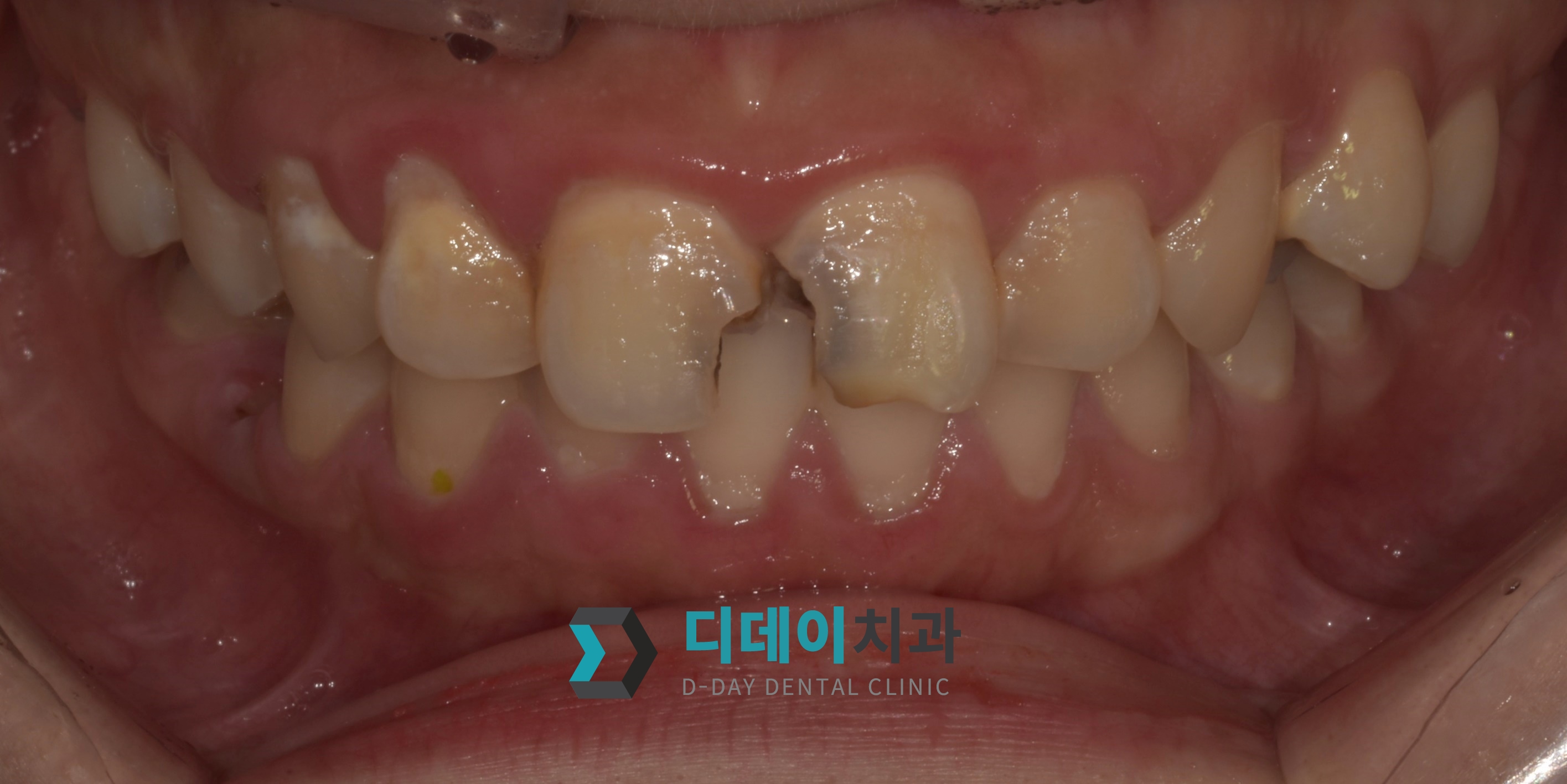 지르코니아 크라운 치료 전