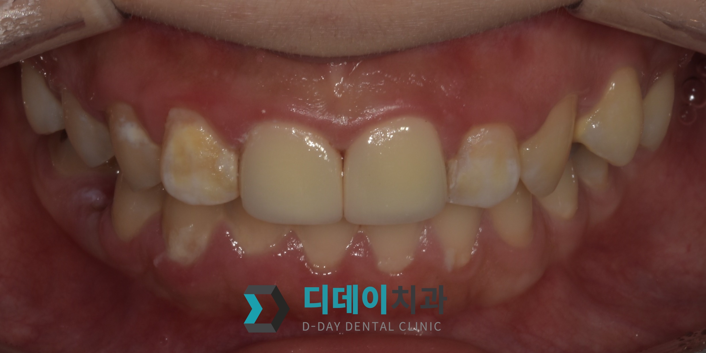 지르코니아 크라운 치료 후