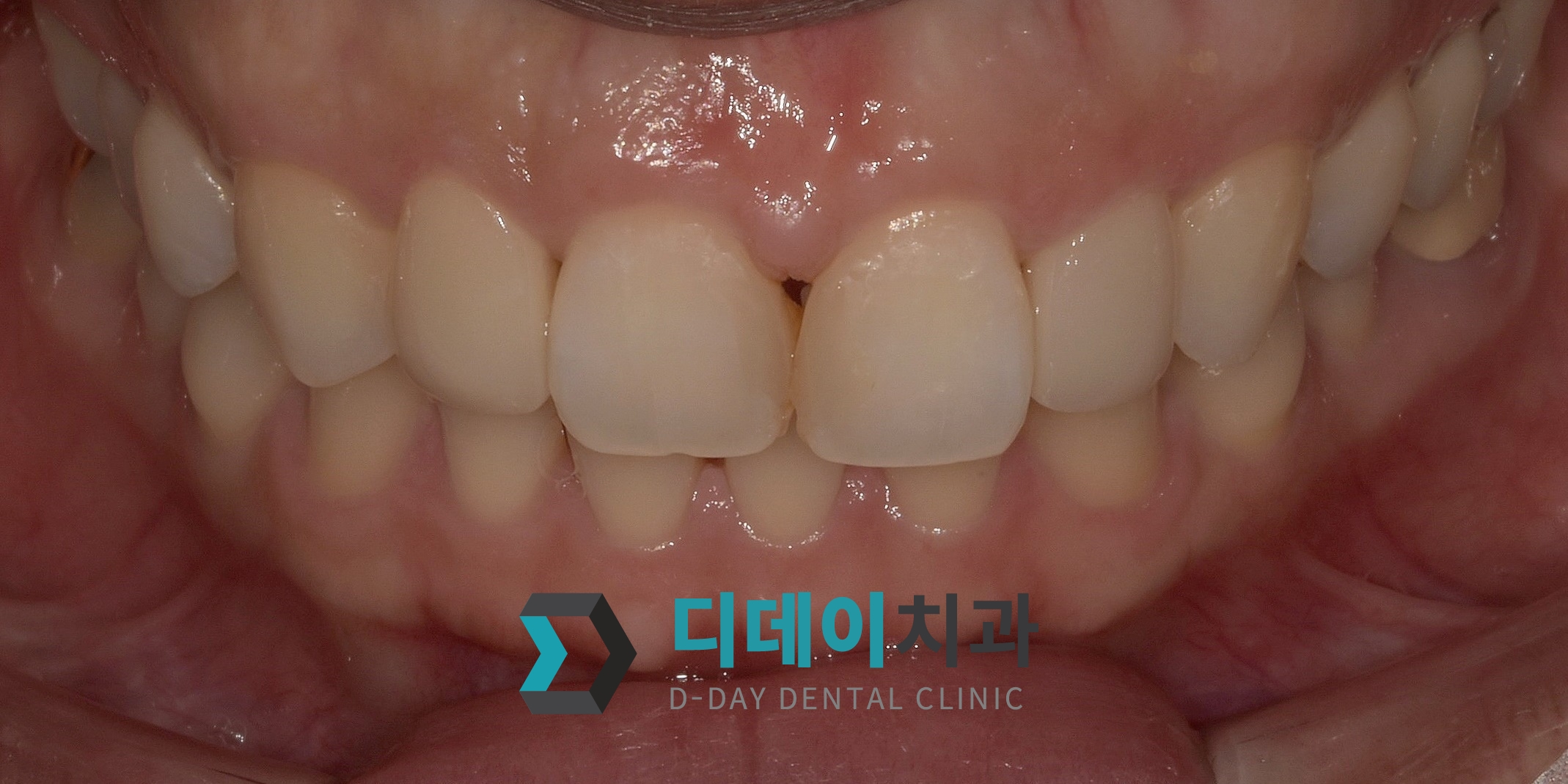 라미네이트 치료 후